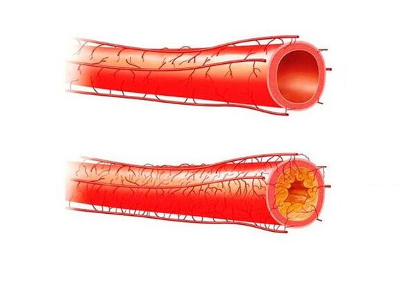 Potency problems caused by blood vessels